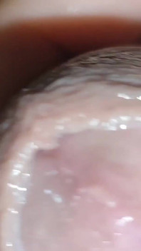 Detaching the Foreskin From the Glans Slowly.