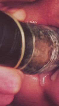 Dilatation Anal