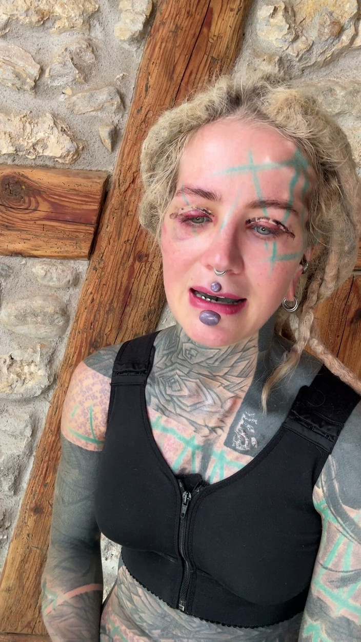 Anuskatzz: Üst Blephoplasti Yolculuğumun 5. Günü.