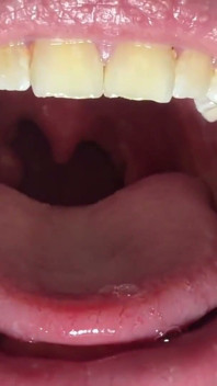 Mulut & tonsil close-up