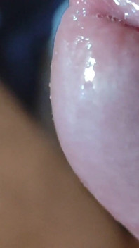 Deep Split in the Glans Produces Bubbling Liquid