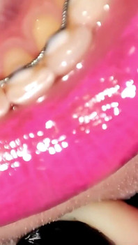 Permanent Retainers Mouth Tour