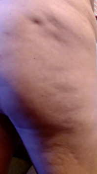 Cellulite Squeeze