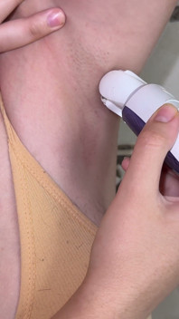 Natural Hairy Young Body! Shaving Hairy Armpits! Epilation of Armpits with an Epilator! Depilation!