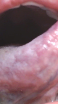 Bên trong miệng lớn của tôi lưỡi răng Uvula