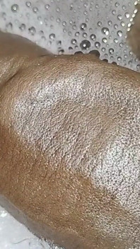 Thick Veins on Cms BBC