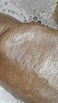 Thick Veins on Cms BBC