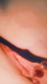Solotease