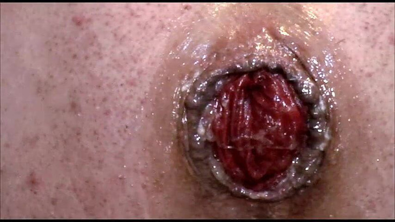 Anita Cocks: Огромная анальная накачка пролапса 20 м