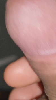 Boy with Large Anal Phimosis Excited!