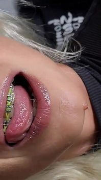 Braces Lovers Attention ️️️last One Month Left to Order Your Braces Custom Video Then Youll Miss Your Chance Because My Braces
