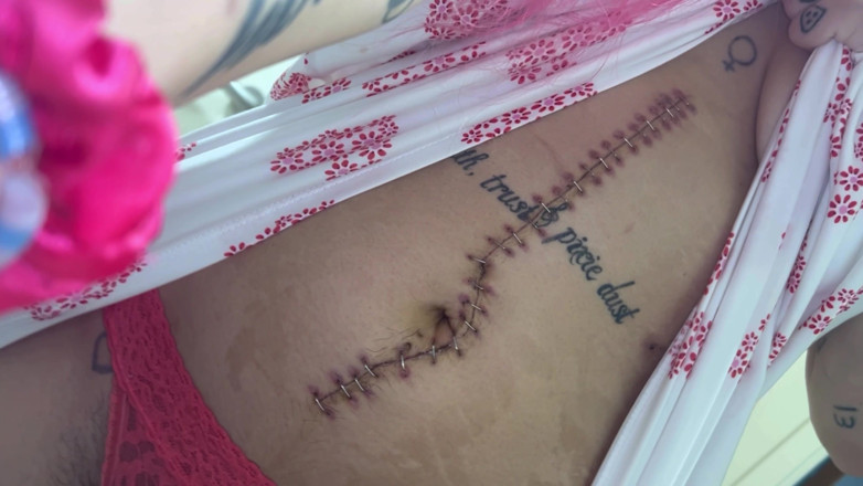 Nali Marie: Scar Fetishes Stitches Staples Hospital Recovery After Surgery Teen Petite...
