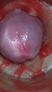 Camera Inside Deep Pussy Captures Very Huge Ejaculation of Sperm Asmr