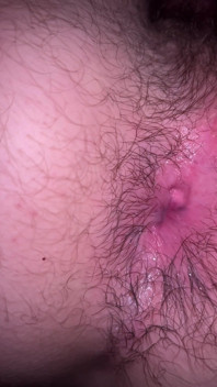 Bruised Asshole