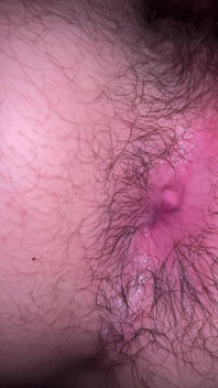 Bruised Asshole