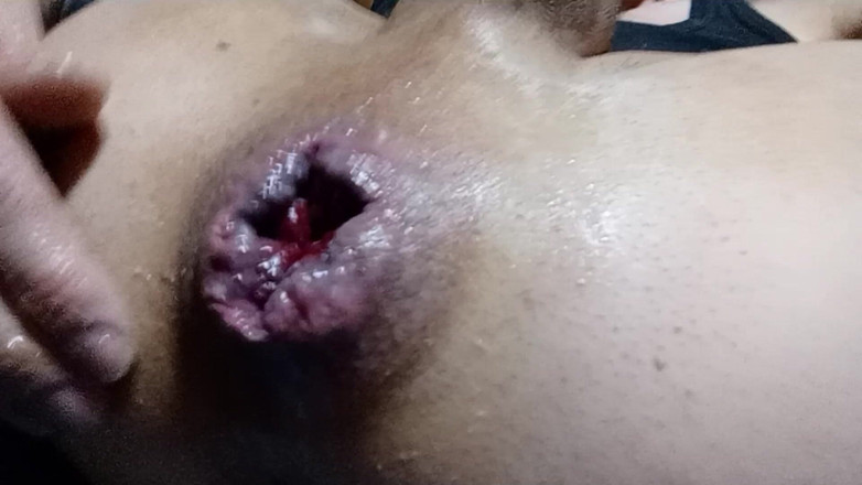 Norbi2888: Fisht anal-spiel