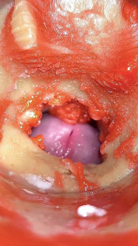 Máy ảnh trong cổ tử cung qua đường hậu môn, bị cucked bởi khổng lồ ''cặp đôi'', xuất tinh vào hậu môn và creampie - asmr