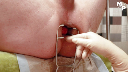 Marcus Pollack: Espéculo esticando para buraco de subs