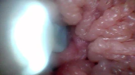 Endoscope Camera Shows the Most Sensitive Parts of the Penis Educational Video