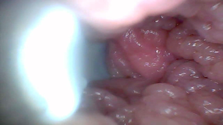 Twittiy: Endoscope Camera Shows the Most Sensitive Parts of the Penis...