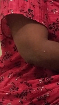 Hot Leg