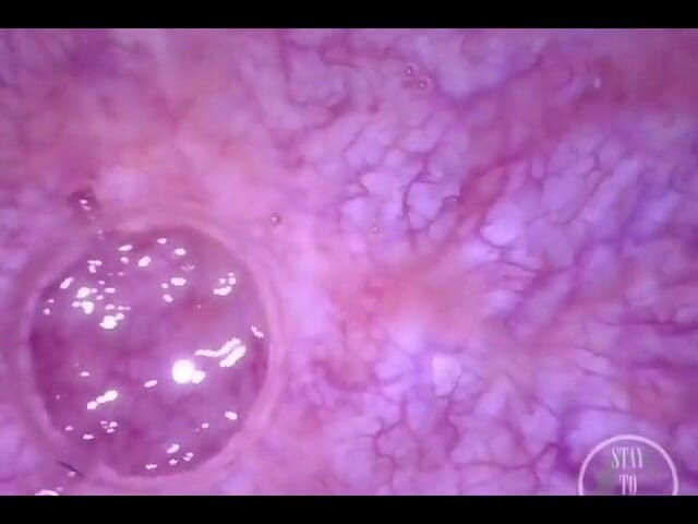 Lina Free: POV endoskop cewnik inflacji pęcherza!