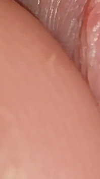 Enlargement of the Deep Urethral Hole!!