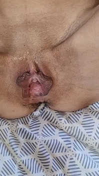 18 Rok Starý Hubená Dospívající Má Extrémní Fisting, Celou Ruku V Kundě