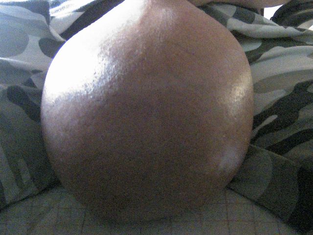 Glucose 5% 500 Ml, Saline 1500 Ml (Pumped Balls)