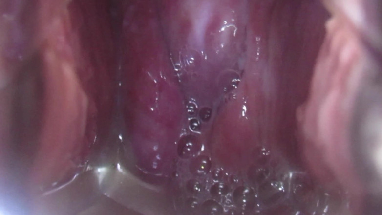 VeeVee Vixen: Cum Cervix Insemination
