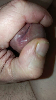 Is My Meatus Open?