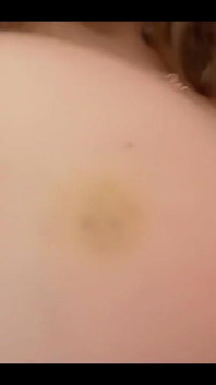 Bruise on Tits Update
