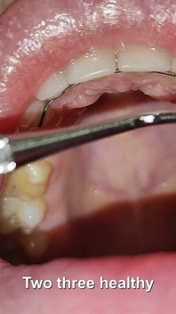 Complete Teeth Exam by the Dentist, Installation of Jewelry