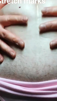 22 jahre caesarean scar