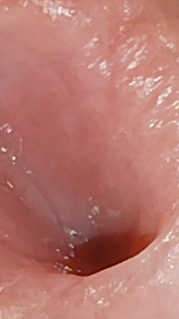 Enlargement of the Deep Urethral Hole!!