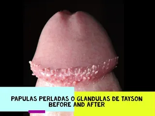 Tayson's glands or pearly papules