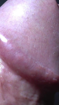 Las glándulas de Tayson o pápulas perladas