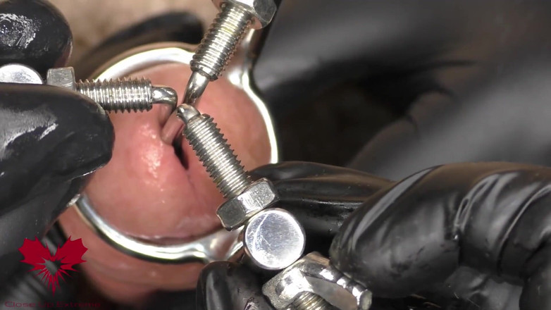 Close Up Extreme: Close up of the Application of a 3-way Urethral Stretcher. the...