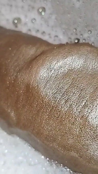 Thick Veins on Cms BBC