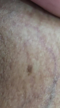 O Que São Essas Manchas No Meu Penis