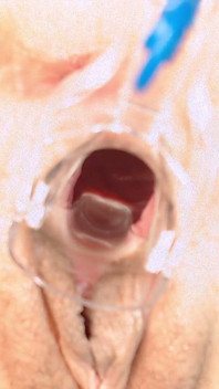 Gyno tôn sùng tìm kiếm cổ tử cung - âm hộ mở rộng với gương gyno