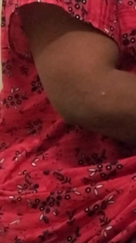 Hot Leg