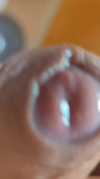 The Glans Appears Crowning Inside the Phimosis.
