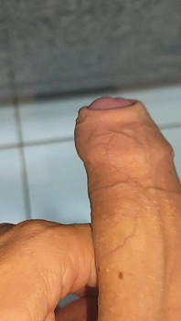 La Gran Transformación De La Fimosis Elástica.