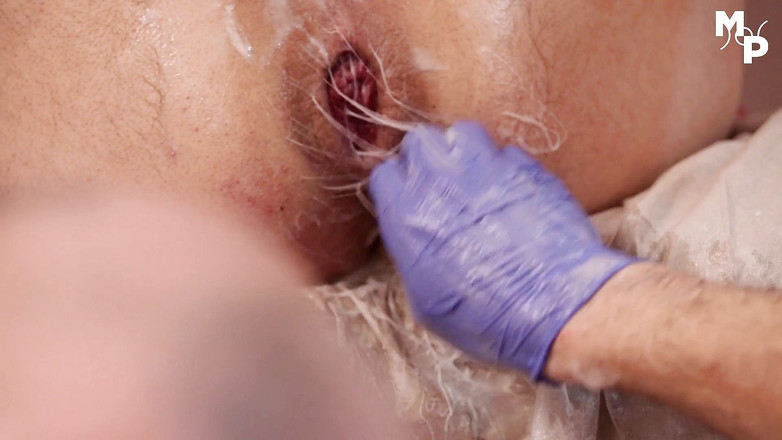 Marcus Pollack Gay: Meninju ke dalam lubang pria