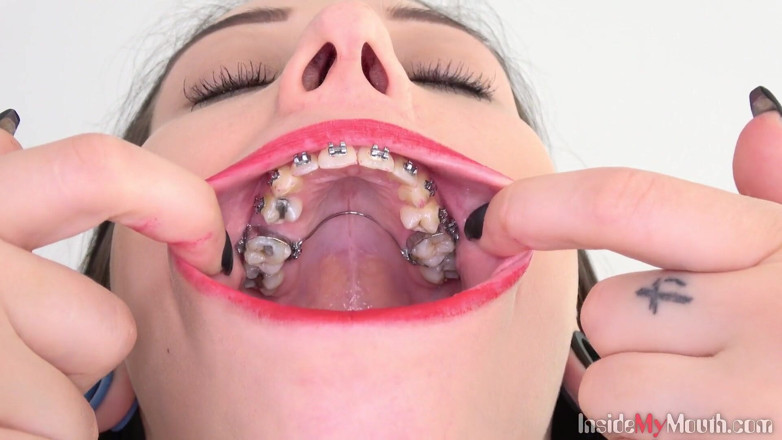 Inside My Mouth: Fetysz ustny wideo z Barą pokazującą aparaty ortodontyczne.