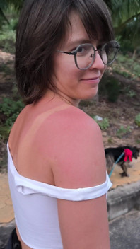 She Really Likes to Sunburn