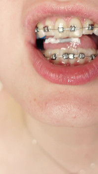 Giantess Devour Fetish in Braces