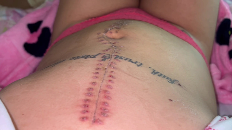 Nali Marie: Scar Fetishes Stitches Staples Hospital Recovery After Surgery Teen Petite...