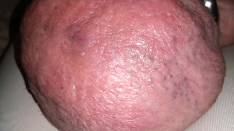 Monster_Meat_: Glukoz 1liter ile dolduruluyor